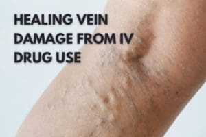 healing veins from IV drug use