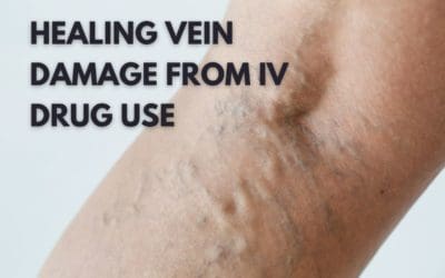 Healing Vein Damage from IV Drug Use