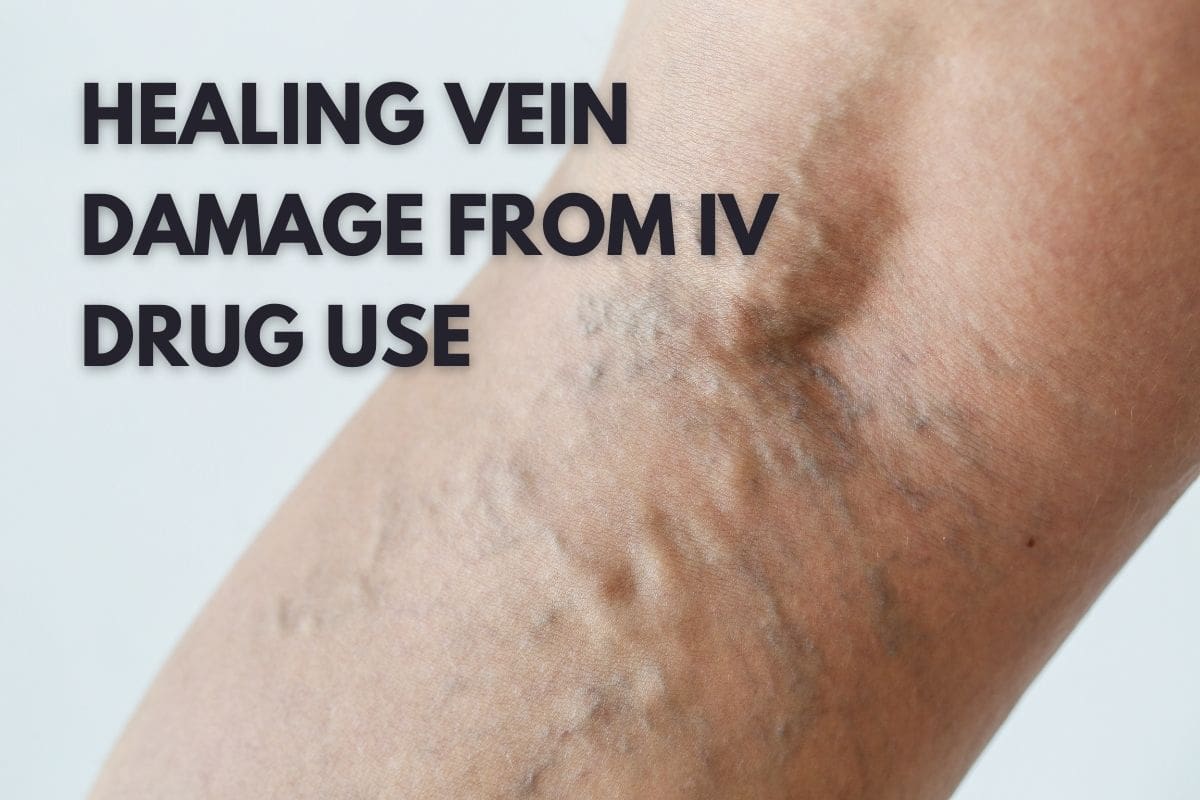 healing veins from IV drug use